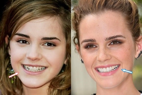 A picture of Emma Watson before and after.